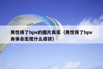 男性得了hpv的图片真实（男性得了hpv身体会出现什么症状）